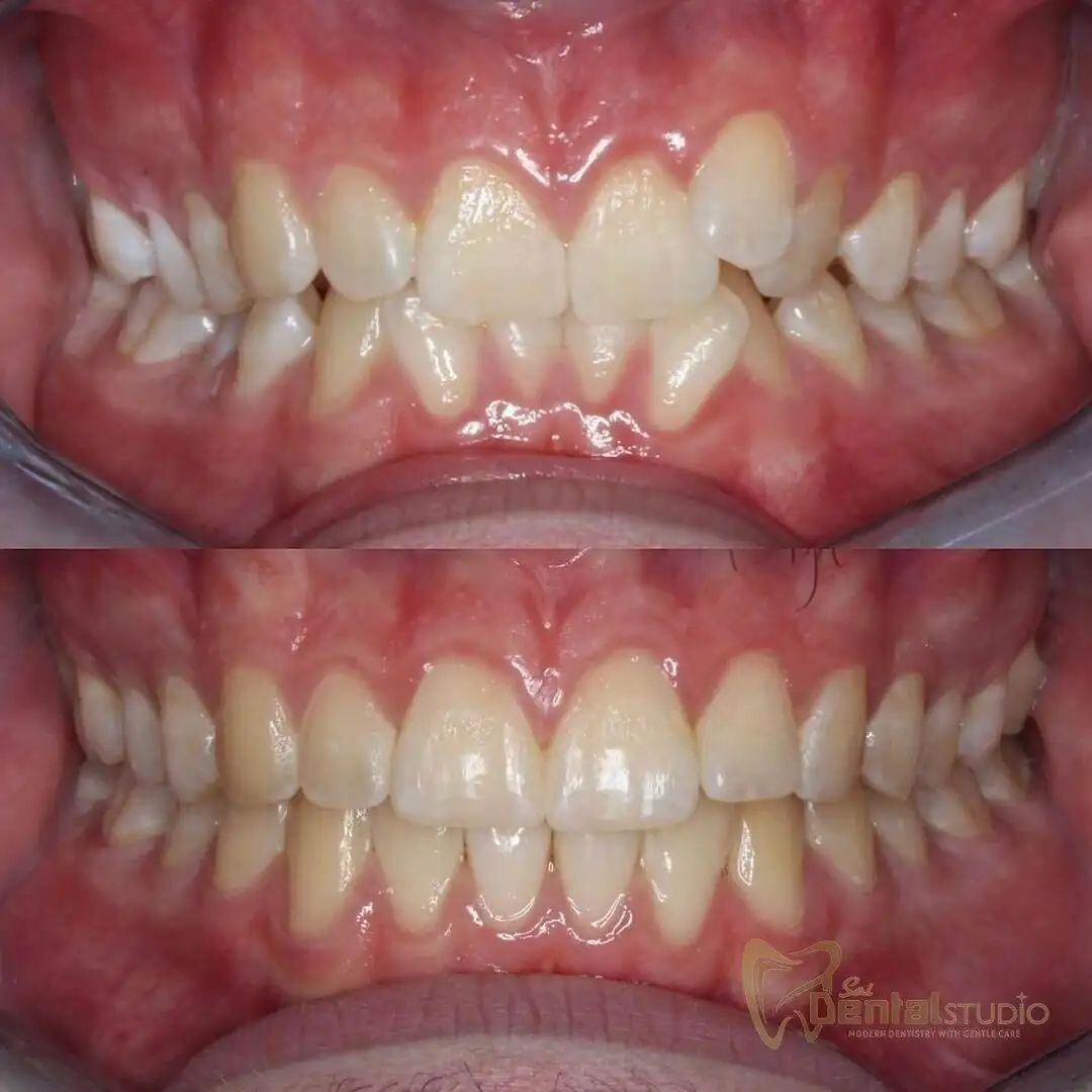 Patient case at Sai Dental Studio