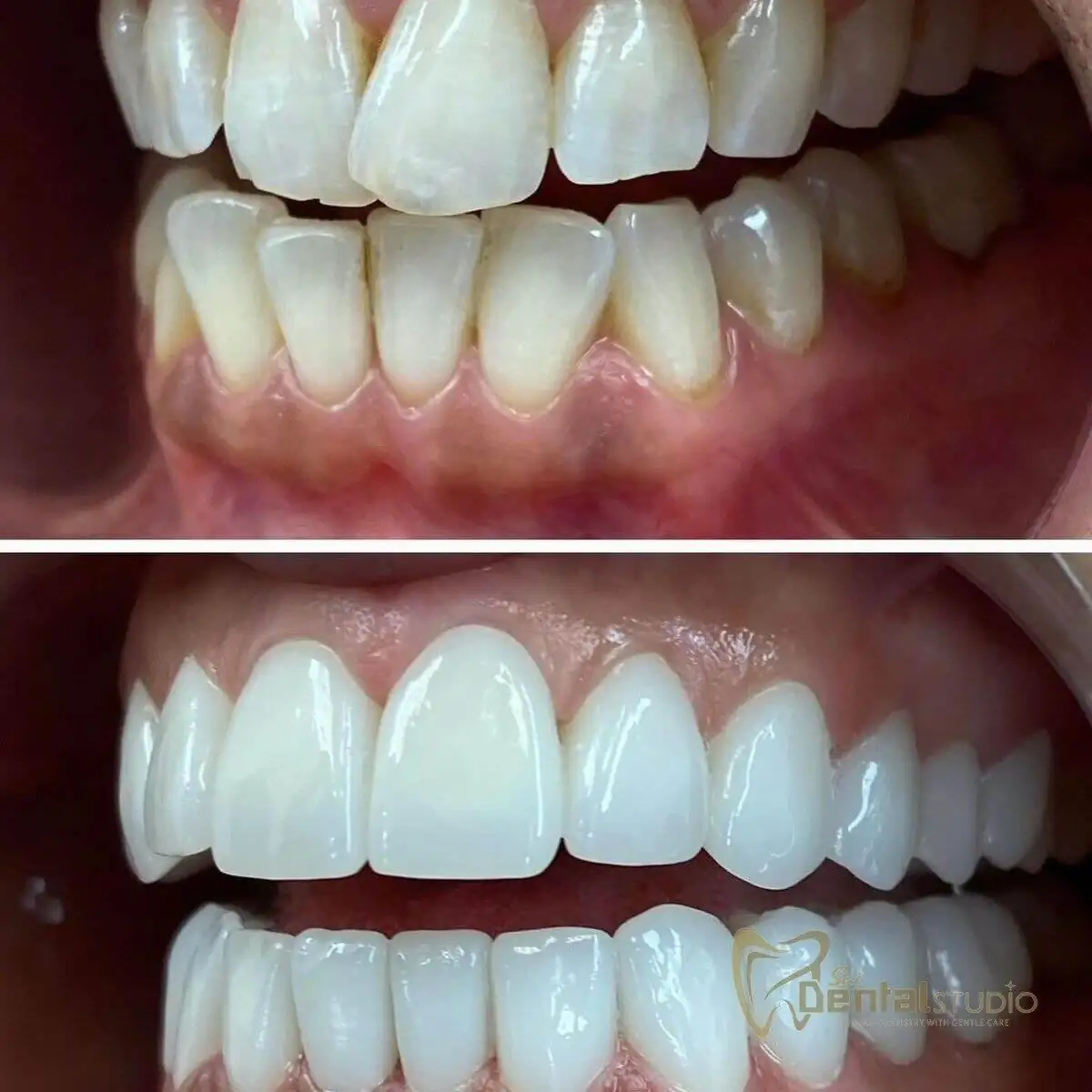 Patient case at Sai Dental Studio
