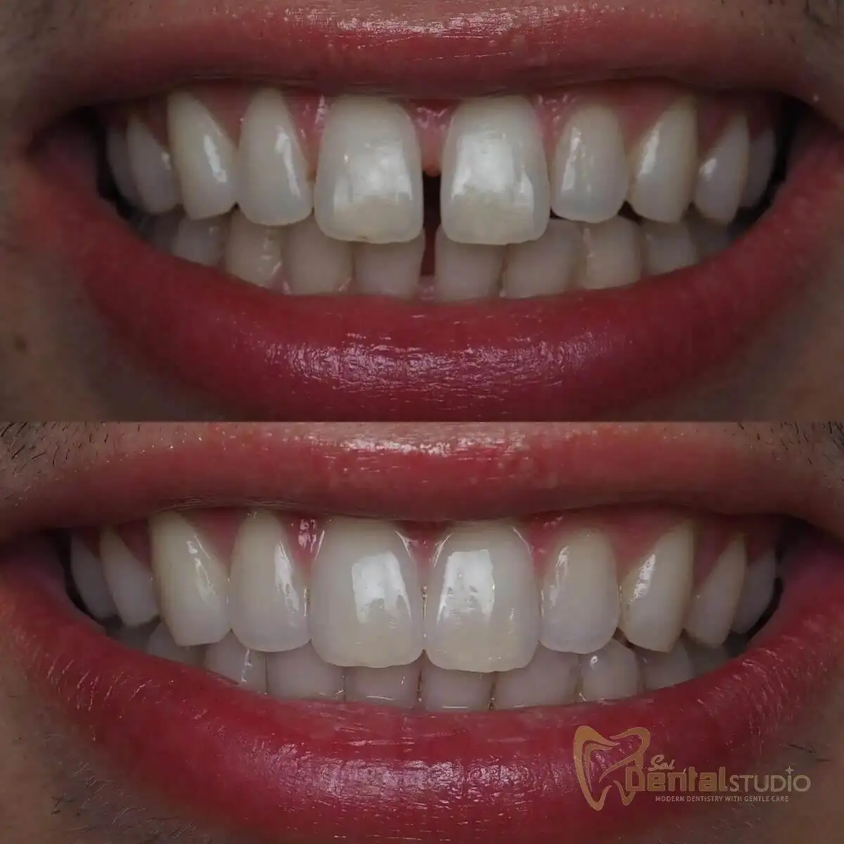 Patient case at Sai Dental Studio