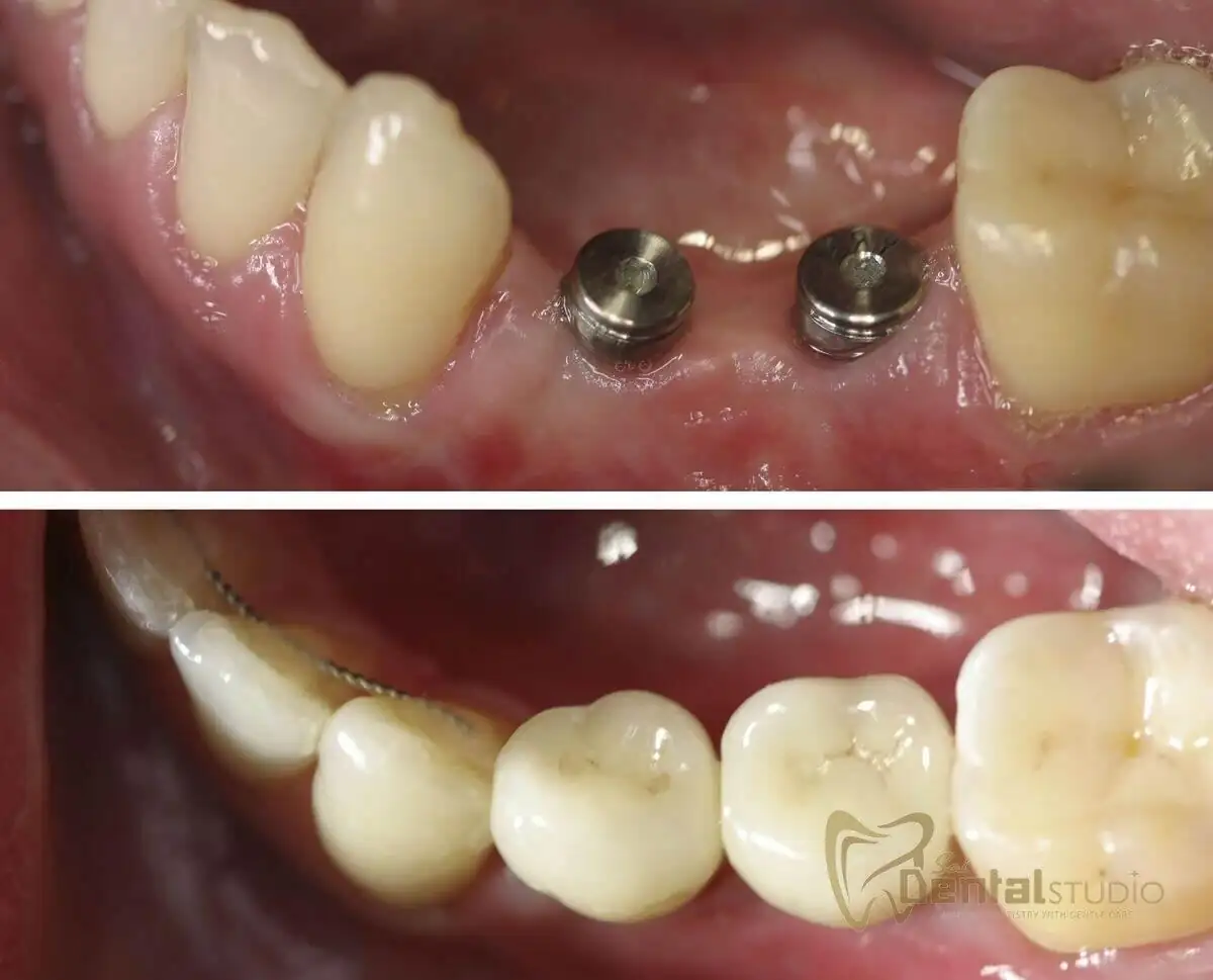 Patient case at Sai Dental Studio