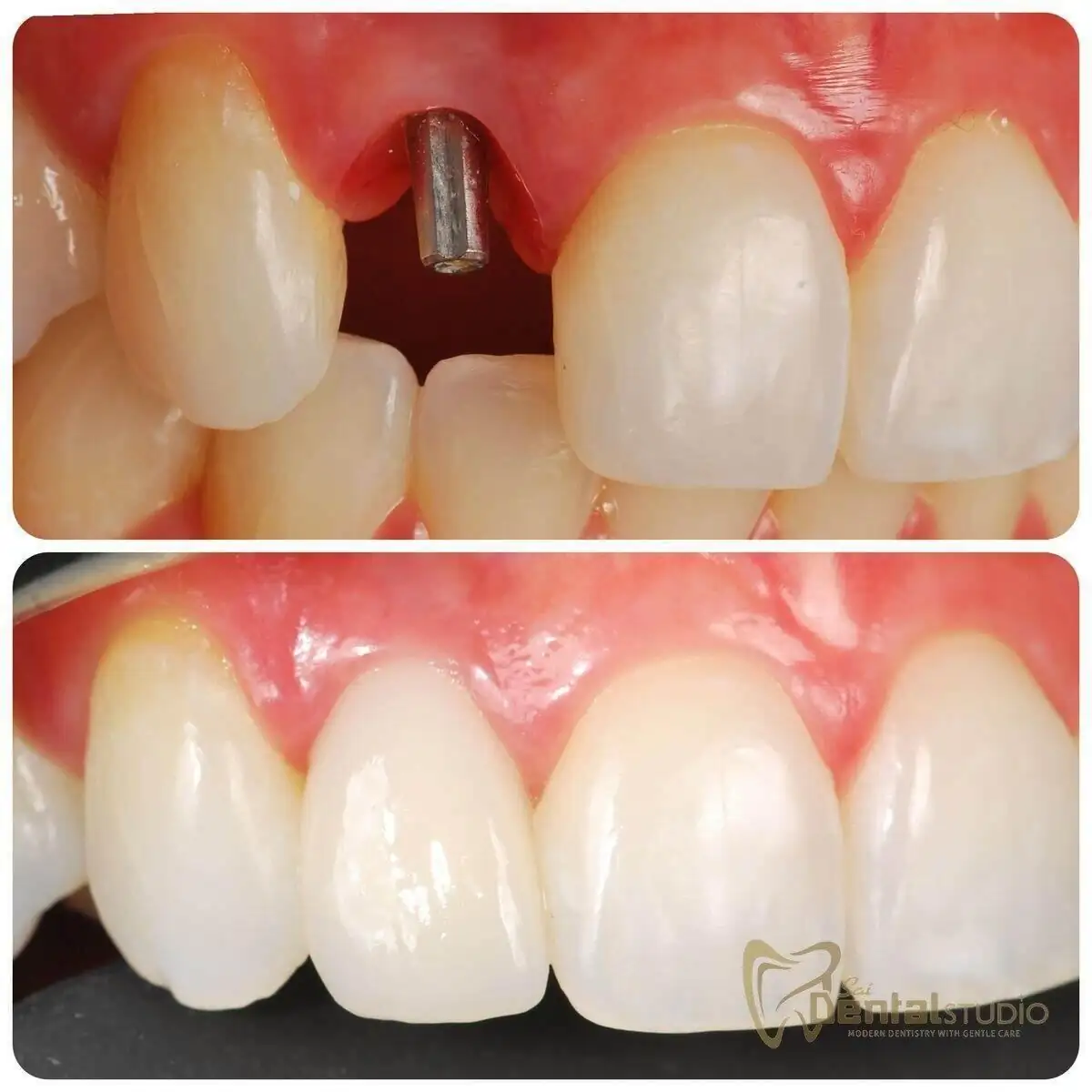 Patient case at Sai Dental Studio