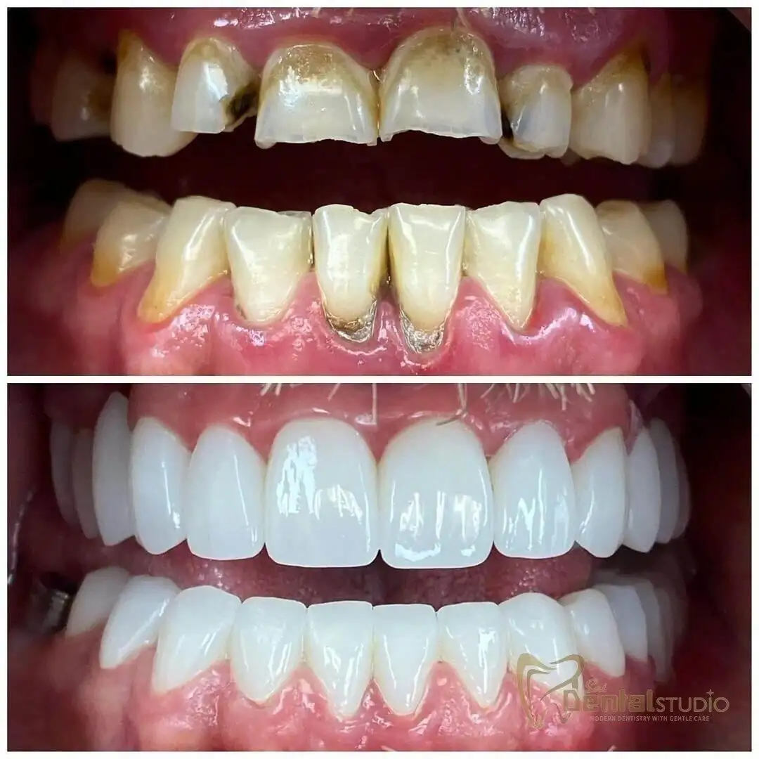 Patient case at Sai Dental Studio