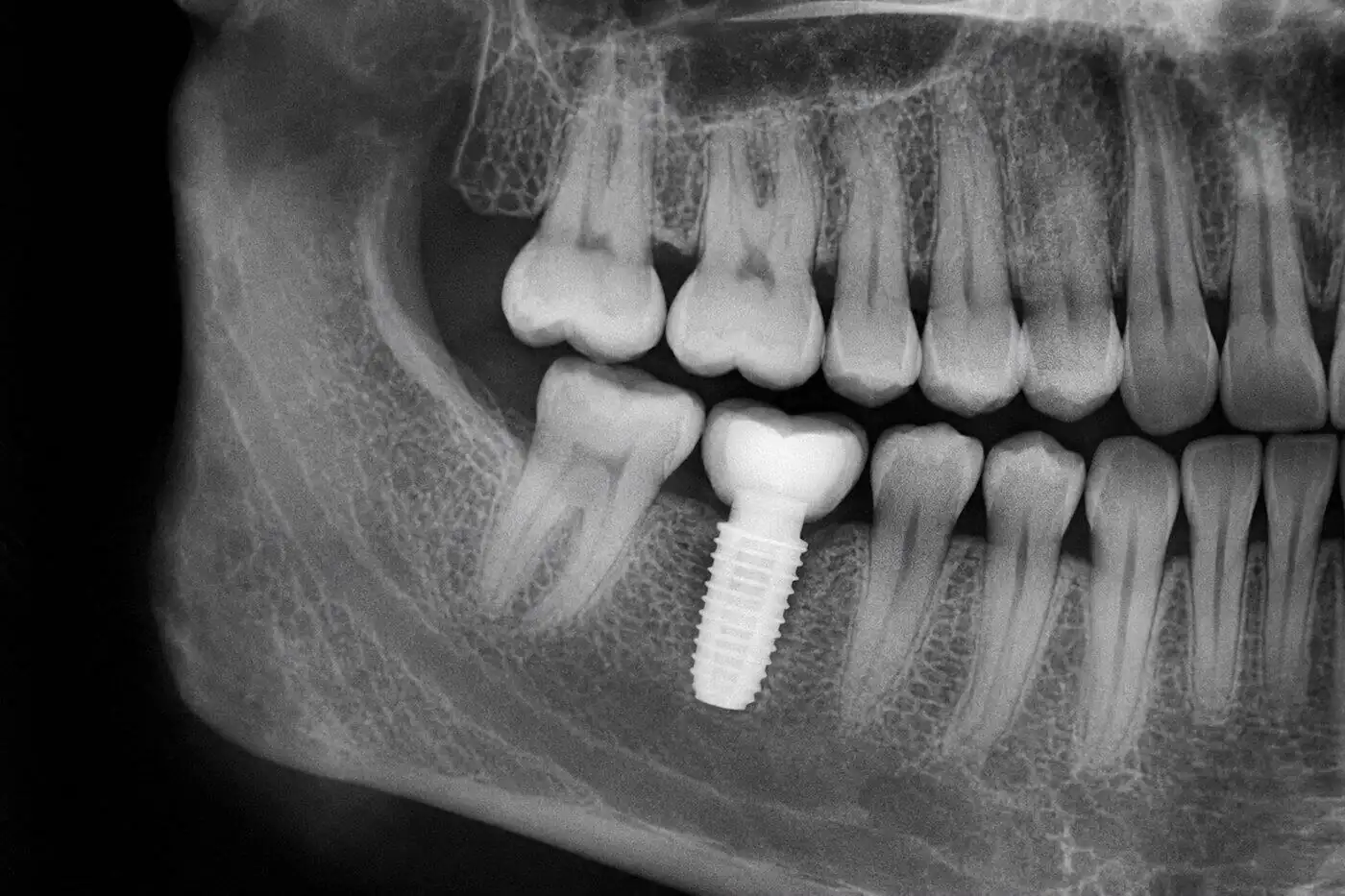 X-ray showing a placed dental implant at Sai Dental Studio