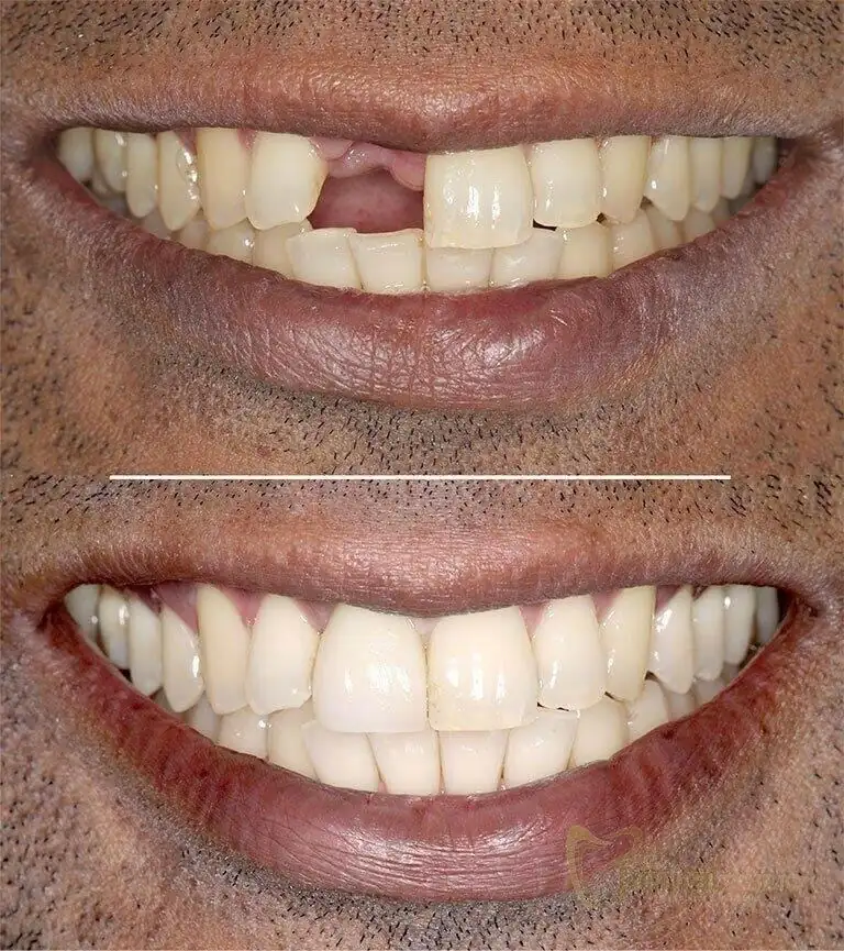 Patient case at Sai Dental Studio