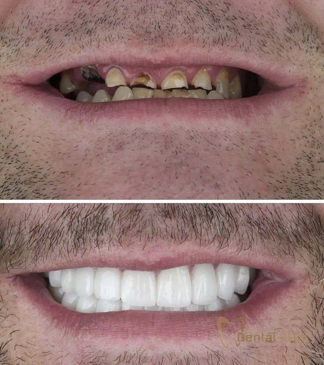 Patient case at Sai Dental Studio