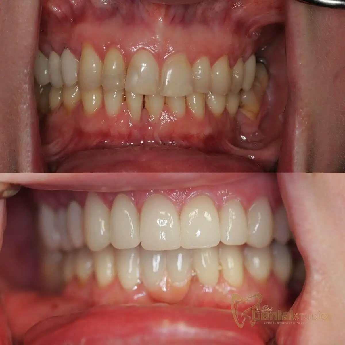 Patient case at Sai Dental Studio
