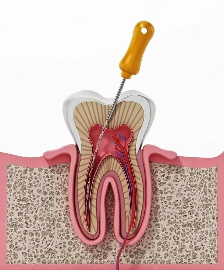 Cross-section of tooth showing root canal instrument