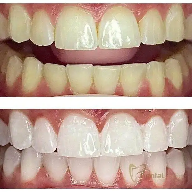 Patient case at Sai Dental Studio
