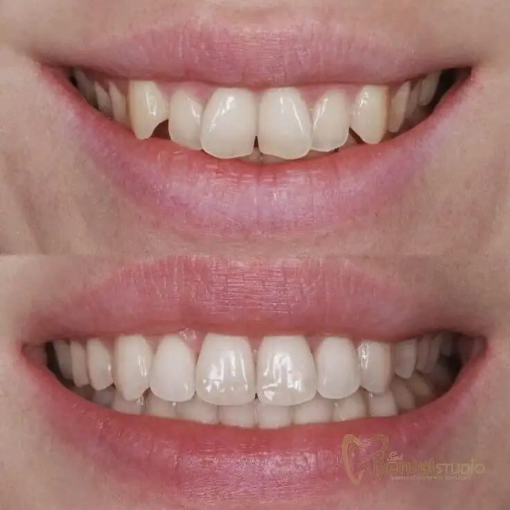 Patient case at Sai Dental Studio