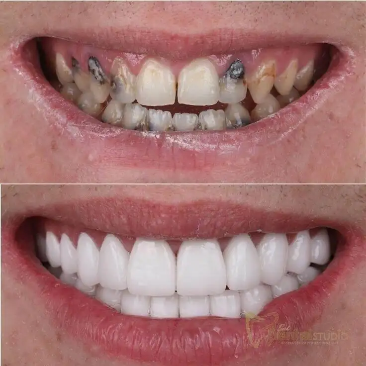 Patient case at Sai Dental Studio