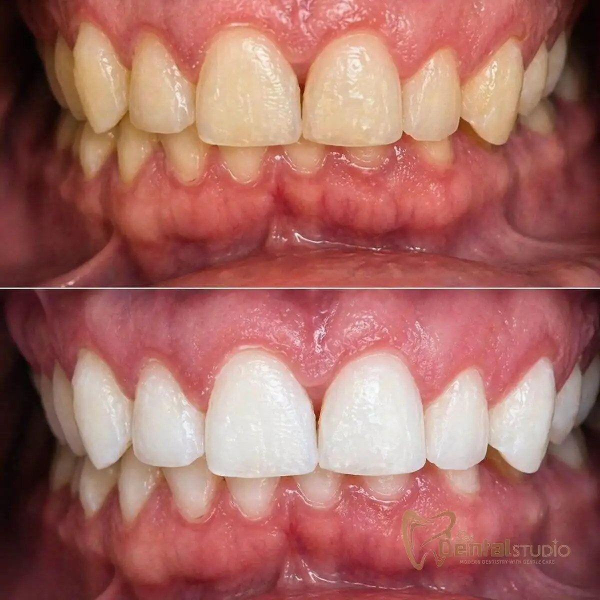Patient case at Sai Dental Studio