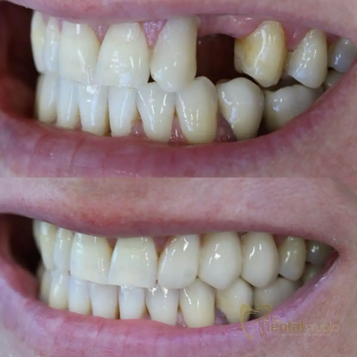 Patient case at Sai Dental Studio