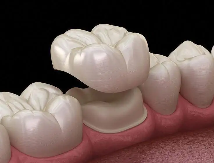 Dental crown restoration