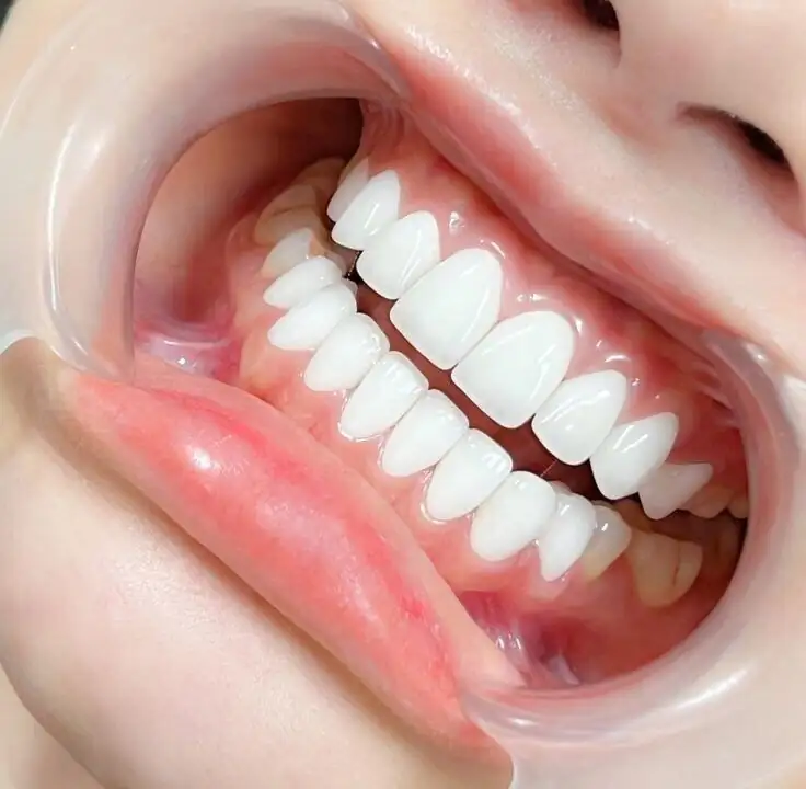 Invisible aligners illustration